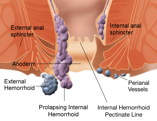 Internal_and_external_hemorrhoids