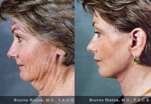 Feel better about yourself: get a facelift!